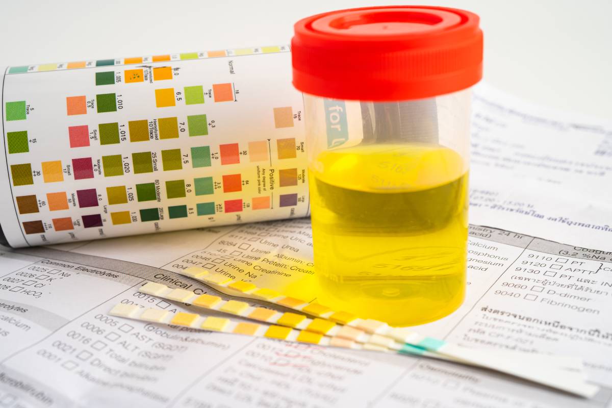 Urinalysis, urine cup with reagent strip pH paper test and comparison chart in laboratory.